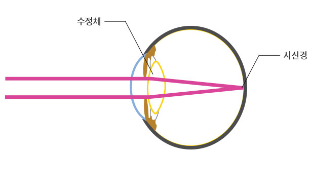 건강한 수정체