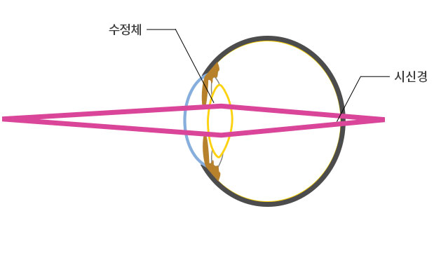 건강한 수정체