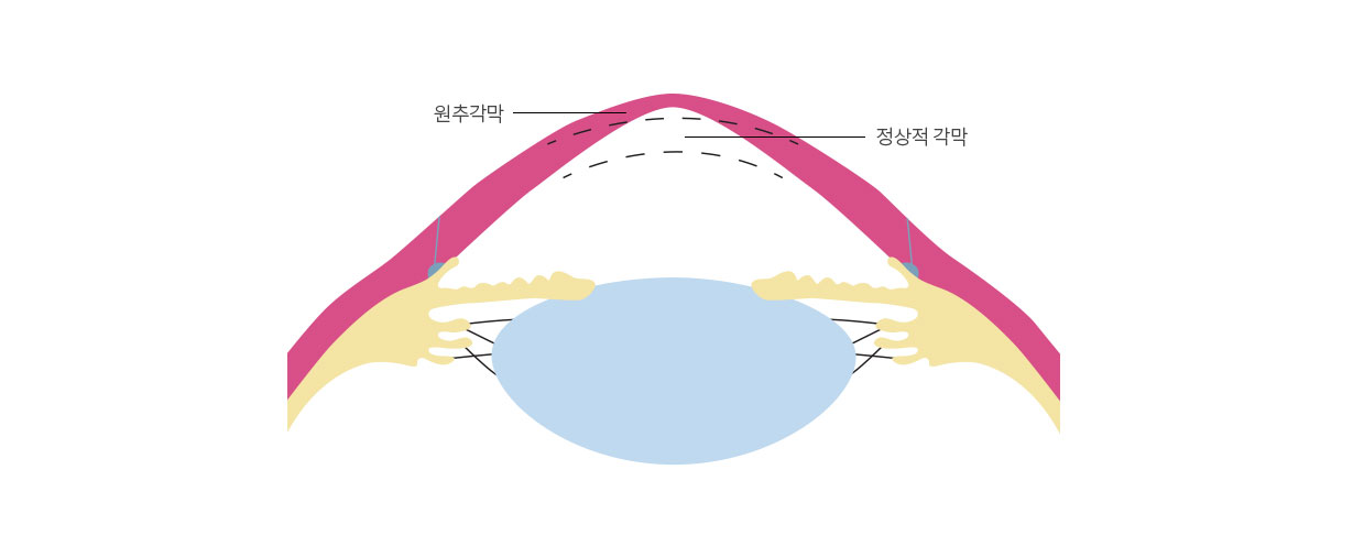 백내장 눈 비교1