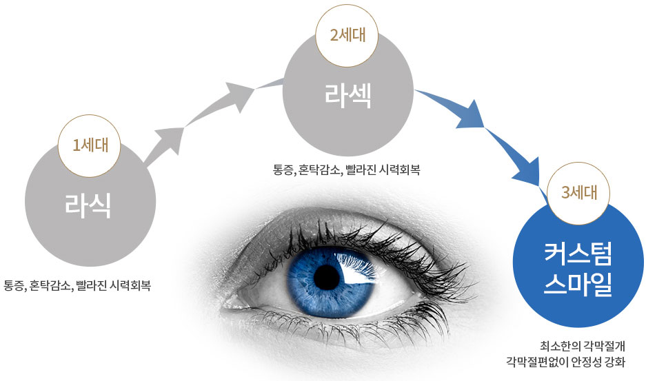 시력교정술의 발전