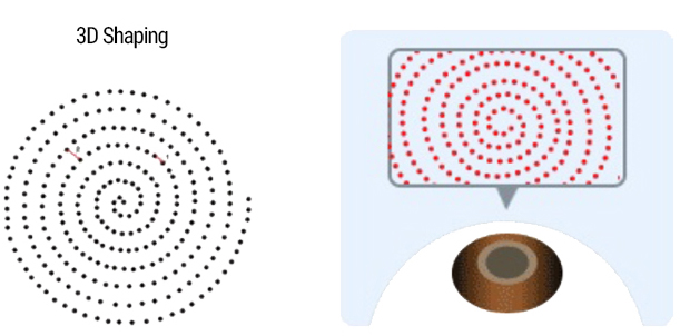 3D Shaping 기술로 저자극에너지 사용