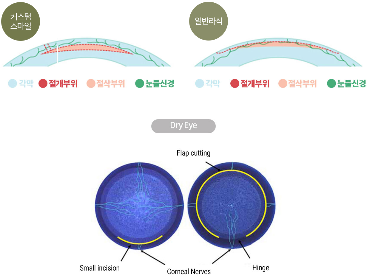 안구건조증 위험 최소화